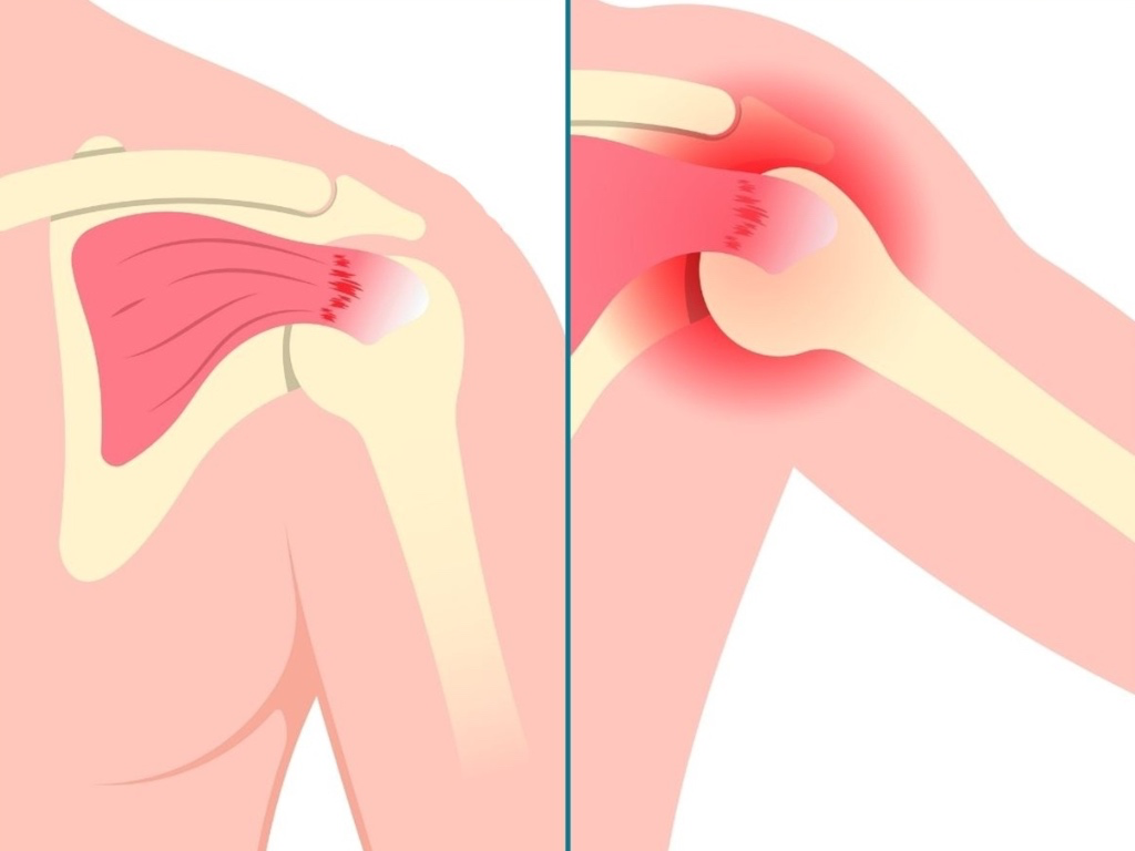 Diagram of rotator cuff shoulder strain